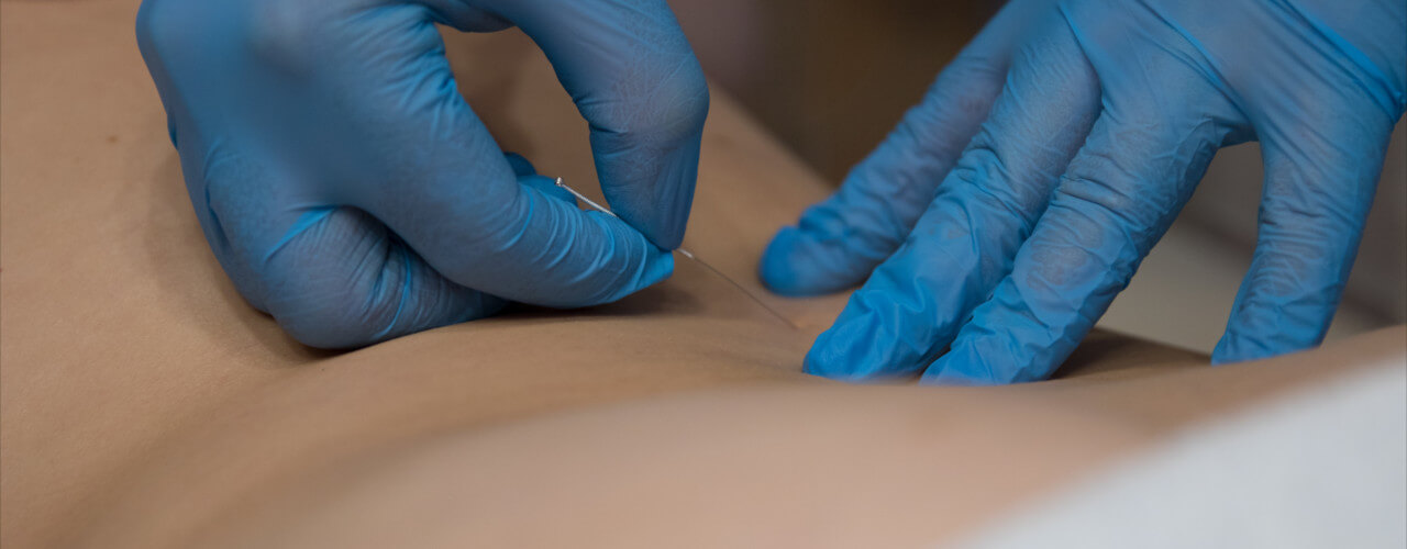 dry needling austin physical therapy