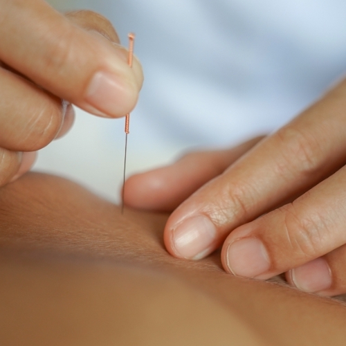 physical-therapy-clinic-dry-needling-austin-physical-therapy-brownsboro-huntsville-al